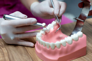 permanent full dental implants